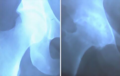 Espuma de artrose da articulación do xeonllo