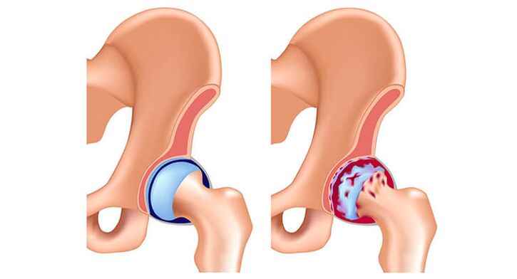 articulación sa da cadeira afectada pola artrose
